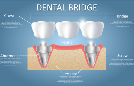 שיקום פה מלא: להחזיר את איכות החיים כשהמצב נראה אבוד