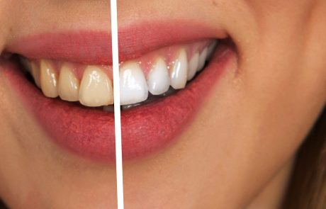 הלבנת שיניים ביתית – האם זה אפשרי?