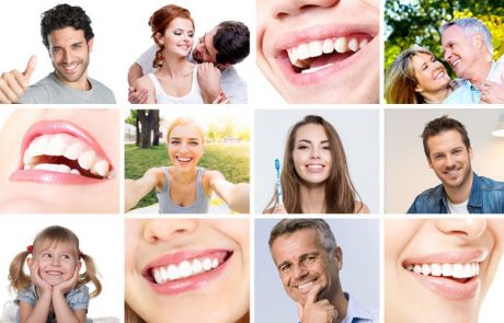 ציפויי שיניים: מה זה אומר?