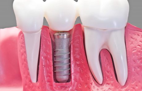 שתלים ביום אחד – פתרון מושלם למחוסרי שיניים