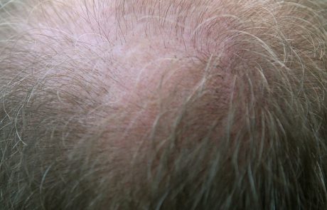 איזה סוג של טיפולי השתלות שיער הכי מתאים לכם?