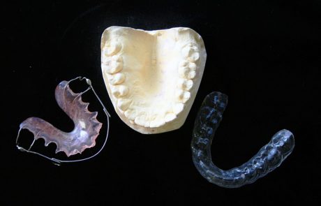 מהן נקודות אחיזה בטיפולי יישור שיניים?